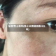 车牌f怎么限号(脸上长黄褐斑看什么科)